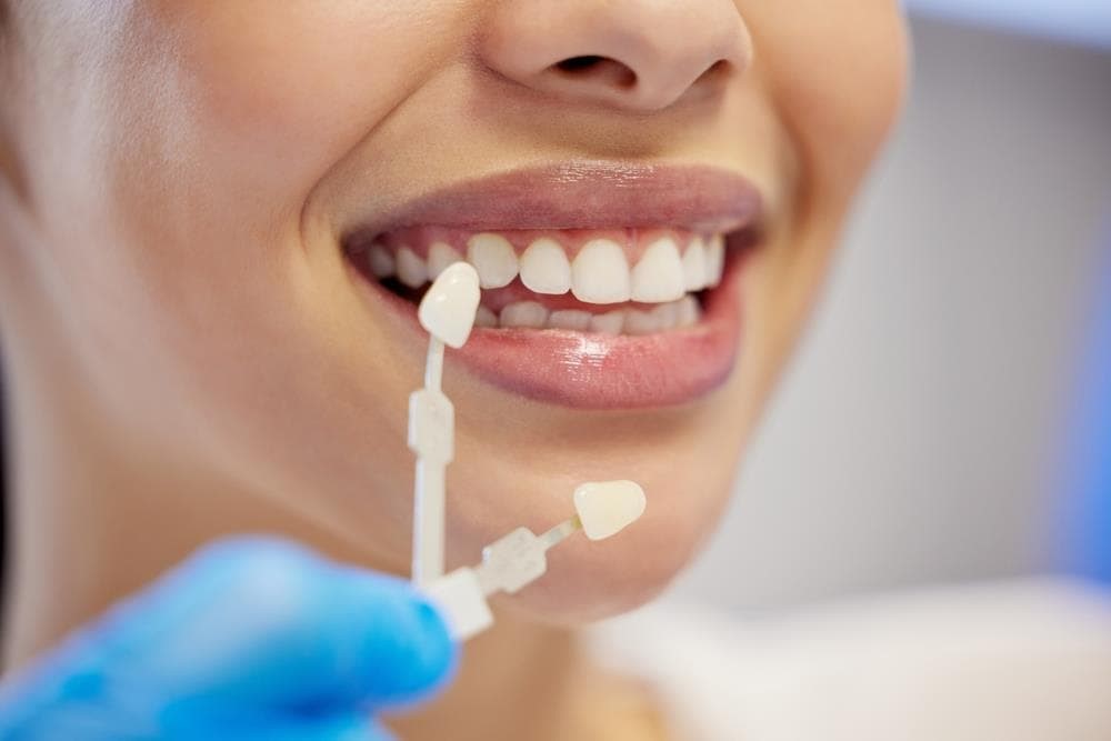 ¿Cada cuánto se puede hacer un blanqueamiento dental?