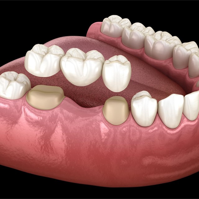 Cómo adaptarte a tu prótesis dental y evitar molestias